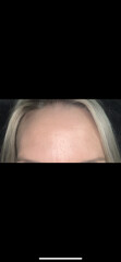 Sad about signs of ageing in 30s, shall I get Botox?