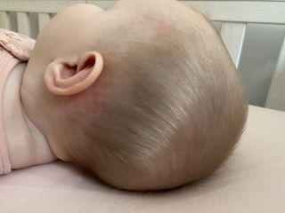 New rash on baby’s head, scalp and chest - pics 