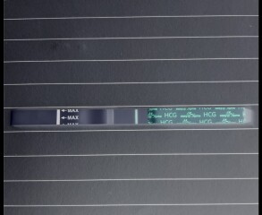 VFL after a misscarriage ?? Help please 