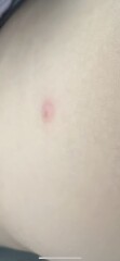 Are these chicken pox ?