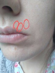 Vertical upper lip lines in my thirties - help!