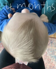 Flat head brachycephaly plagiocephaly