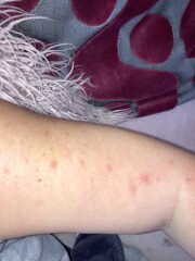 To be worried about this rash?