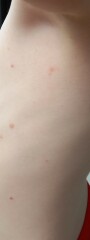 Is this chicken pox?