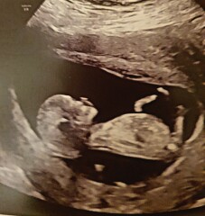 What do you think.. Boy or girl? 12week scan