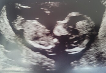 Gender guess - 12 weeks