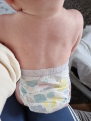 Rash on baby