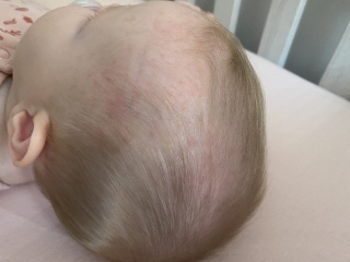 New rash on baby’s head, scalp and chest - pics 
