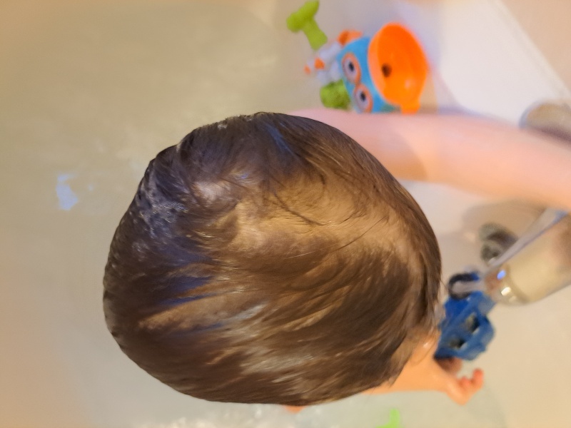 How severe is this plagiocephaly?