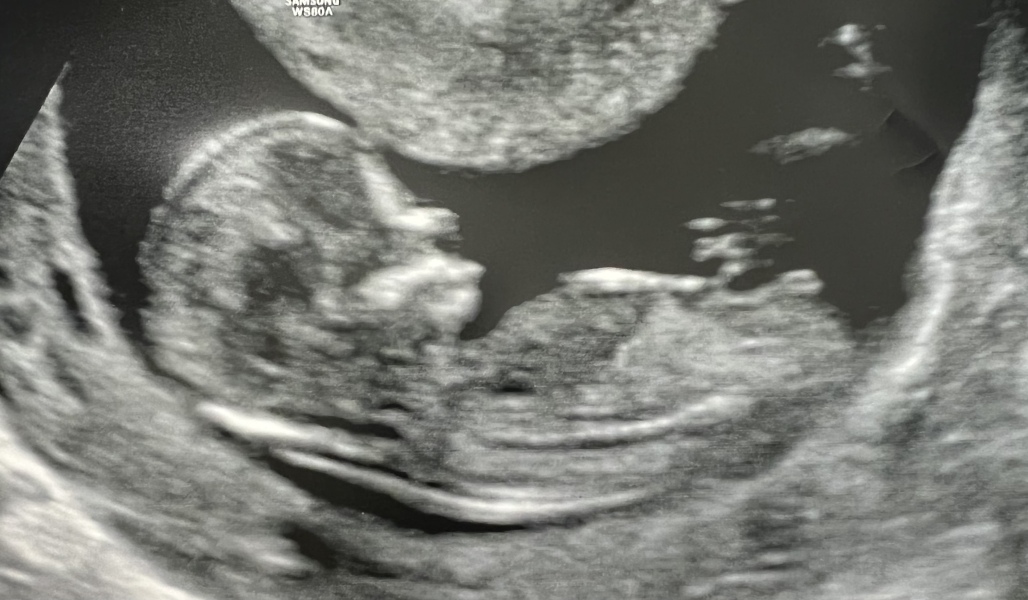 12 week scan guess the sex?