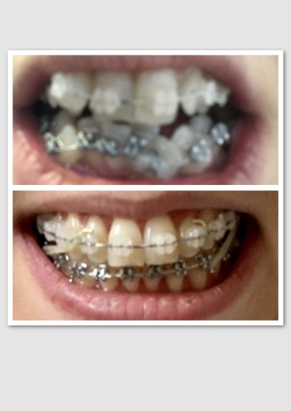Invisalign vs Fixed braces experiences. 