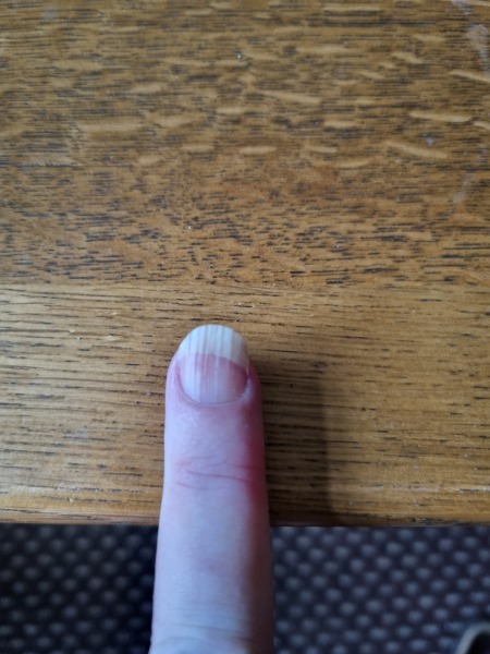 White of nails