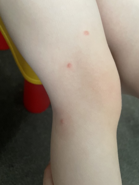 Is it chickenpox (and if not what is it?)