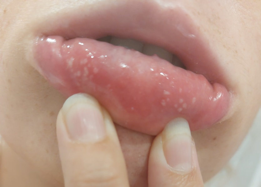 What's going on in my mouth?! Pic