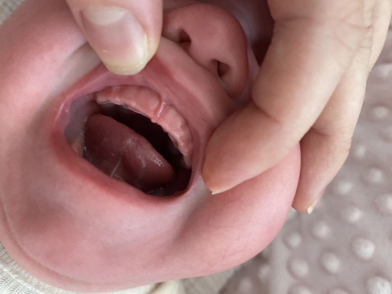 Tongue tie at 6 months 