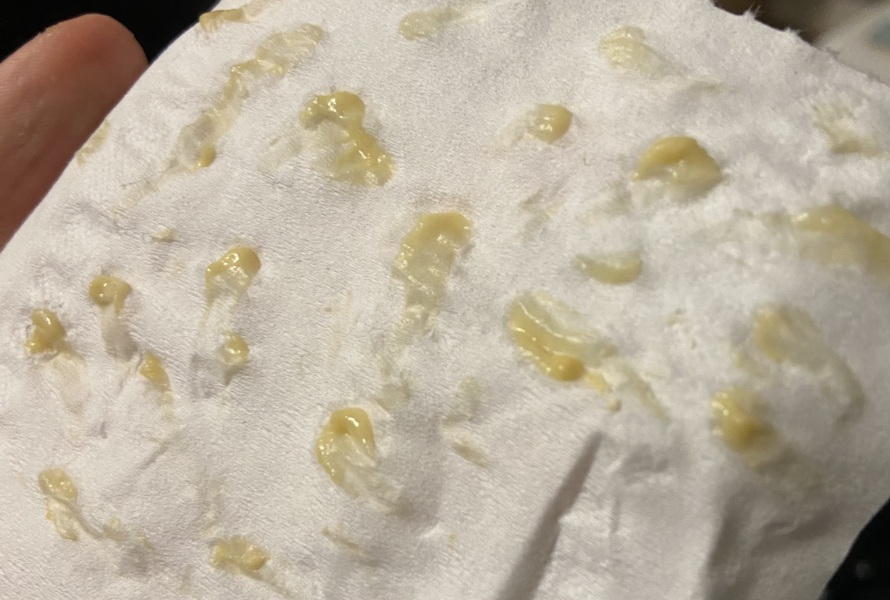 Is My Earwax Normal? (Pic)