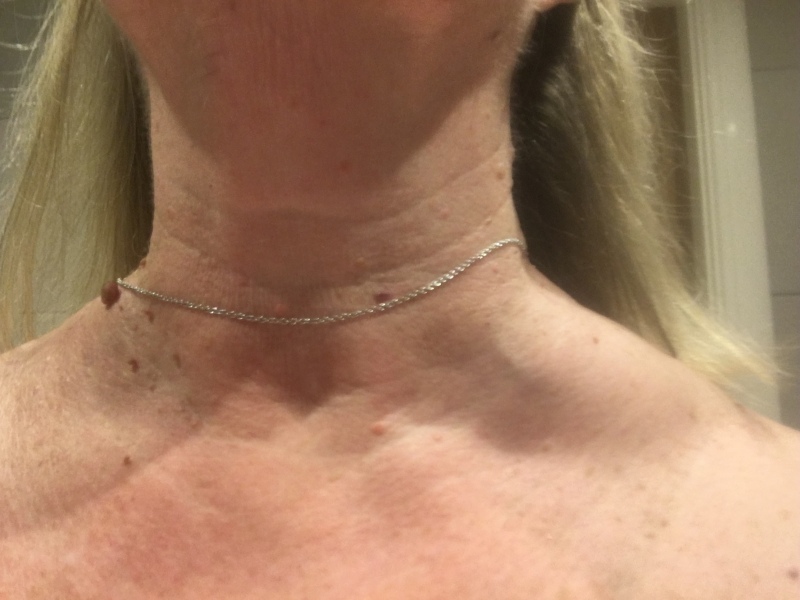 What is this swelling above my collar bone.