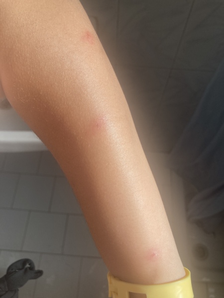 Help Please - are these mosquito or bed bug bites 