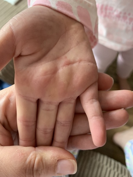 Hand, foot and mouth ?