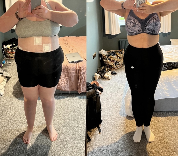 Bariatric surgery thread 3
