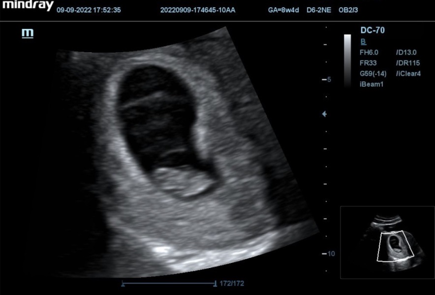 8 week scan - Ramzi Theory