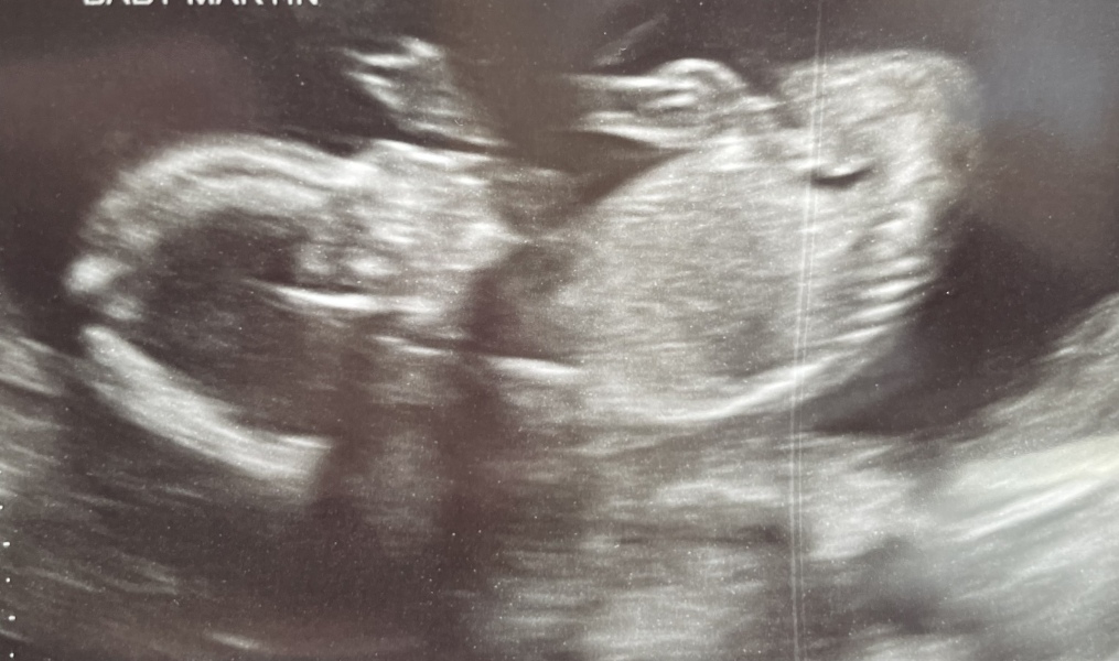 18 week scan - Can anyone tell if this is a boy or girl?