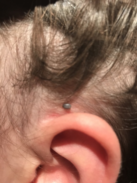 What is this I’ve found on my daughters head? Is it a tick? 