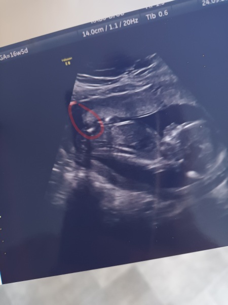 Due March 2023 - thread 3