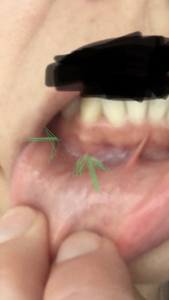 Base of tooth poking through gum. Any dentists about?