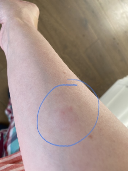 To ask what bit me and do I need to see a doctor 