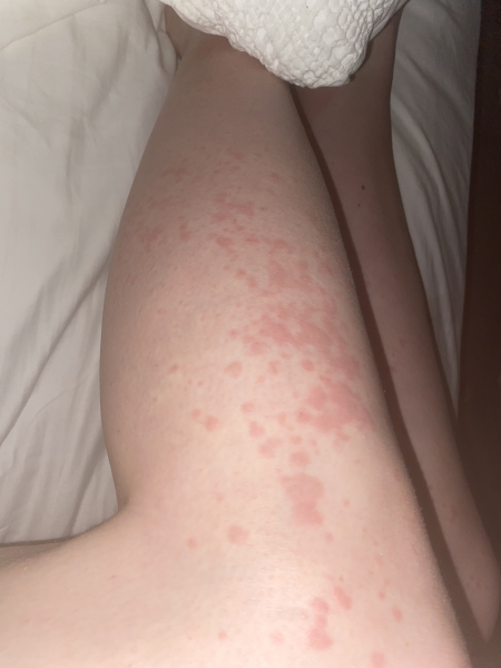 Hives all over body all of a sudden