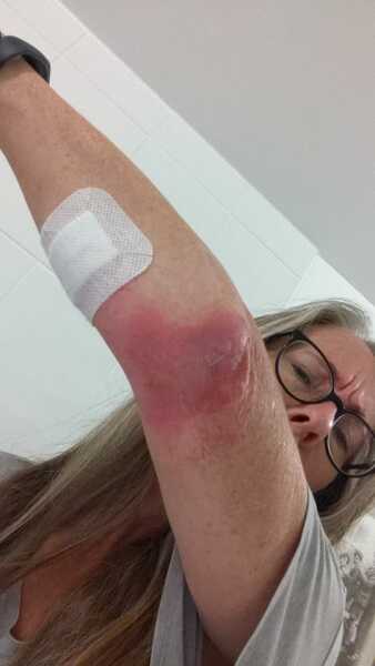 Burn advice (again sorry) (picture included ..sorry!)