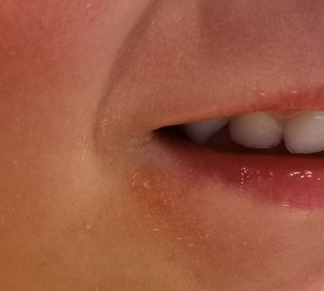 Sore near mouth 