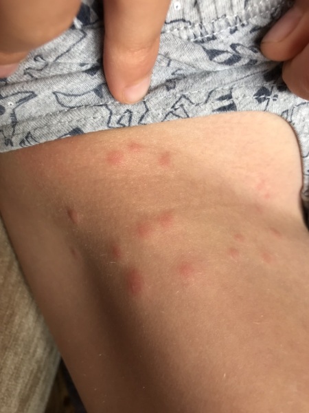 Rash on son and myself