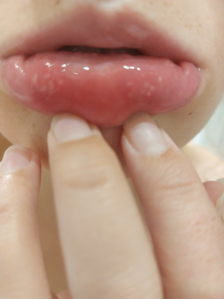 What's going on in my mouth?! Pic