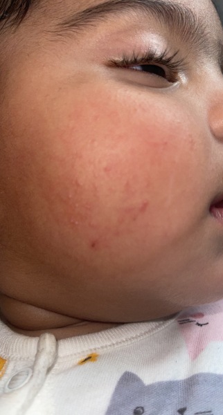 Baby spots