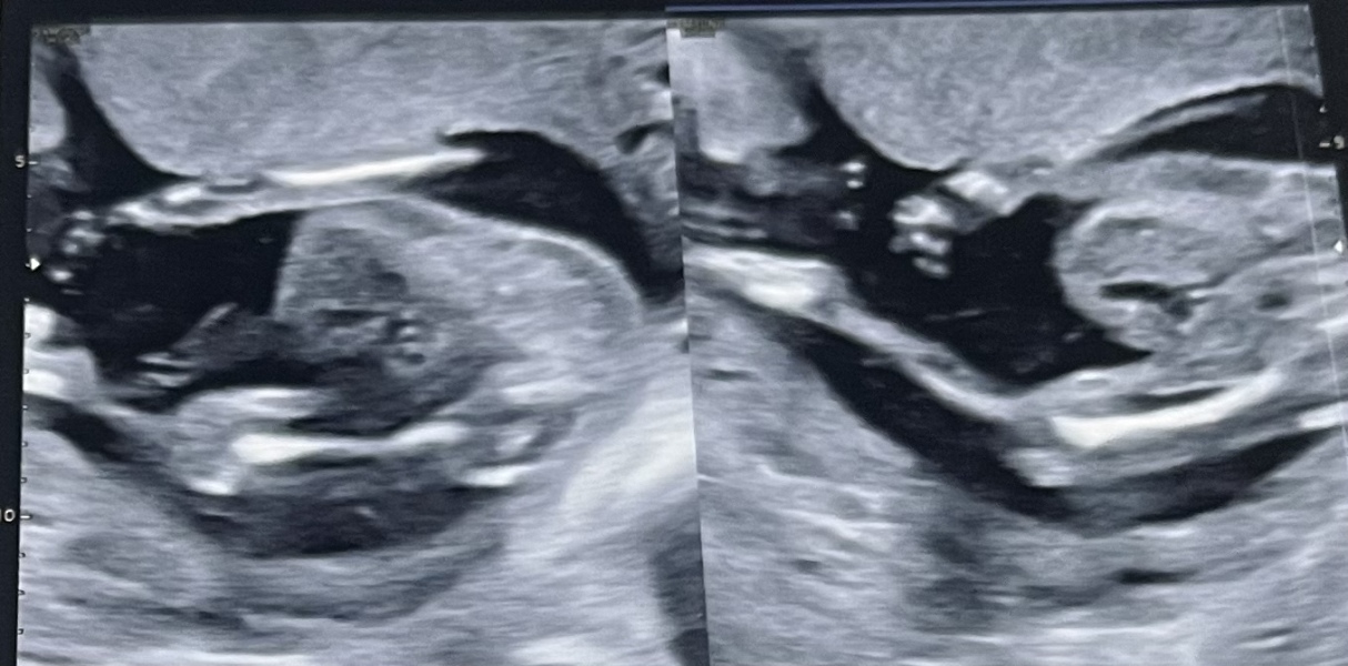 Baby has bilateral renal fullness..