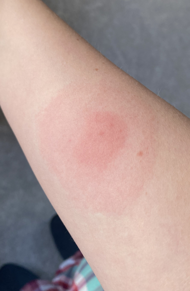 To ask what bit me and do I need to see a doctor 