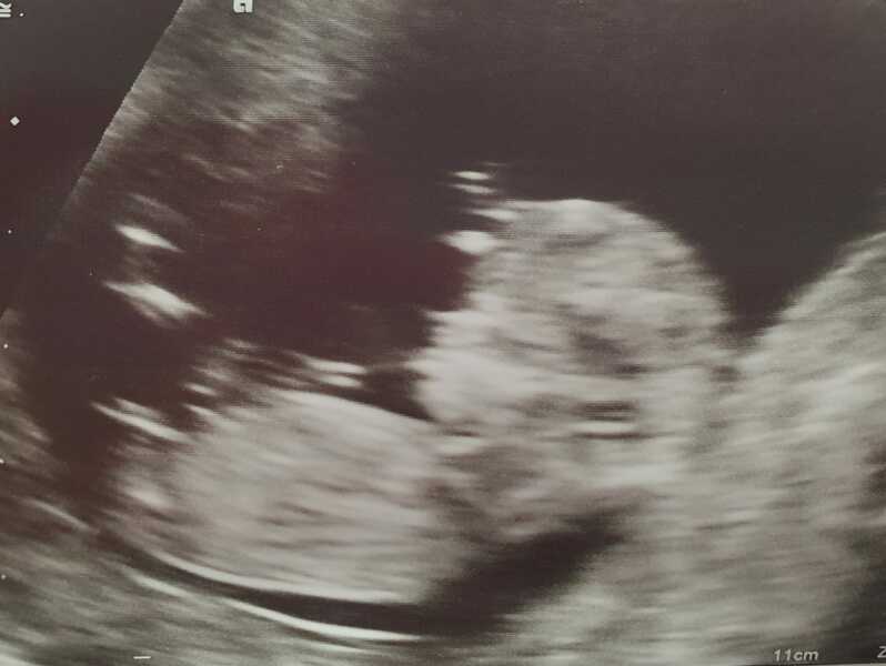 Nub theory - boy/girl guesses welcome please!