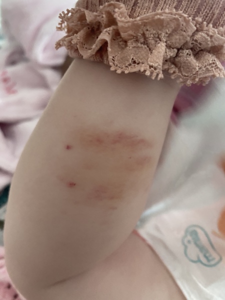 Markings on child’s leg 