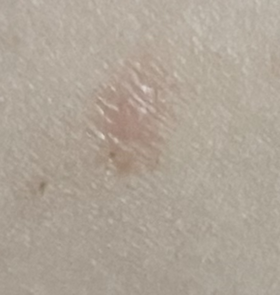 Chickenpox despite vaccine?