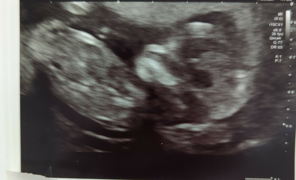 Due March 2023 - thread 3