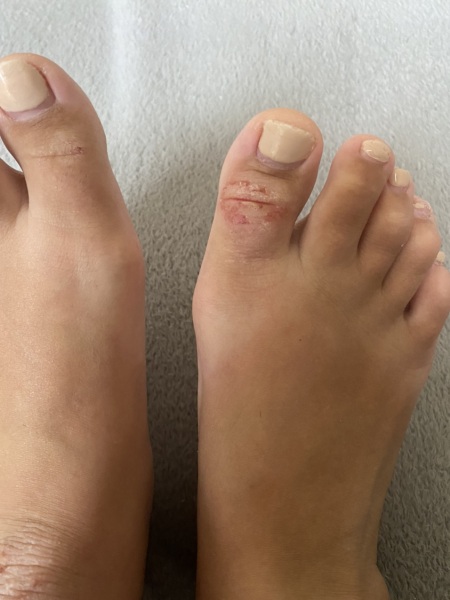 To ask you if these are bunions?
