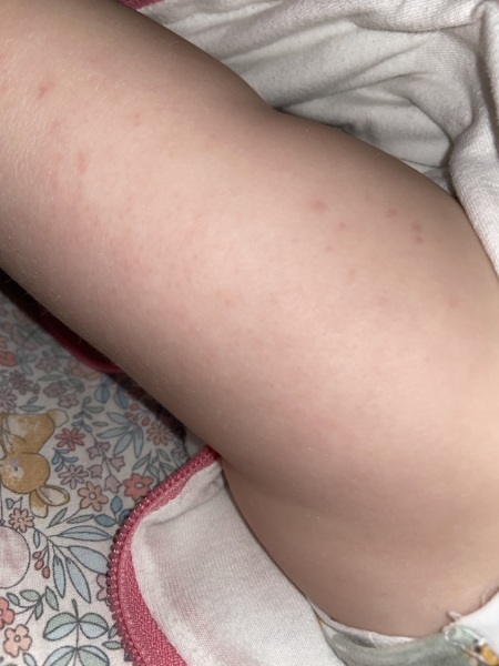 To think this is chicken pox?