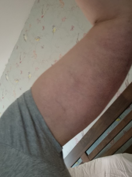 I had a body lift in Turkey AMA