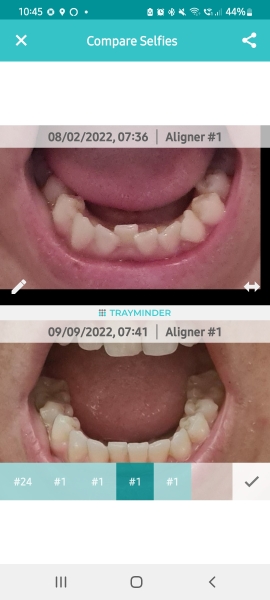 Is Invisalign worth it?