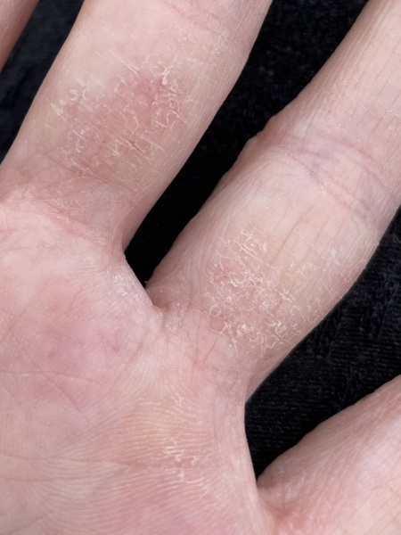 Stuck in an endless cycle of steroid cream - arghhh!!