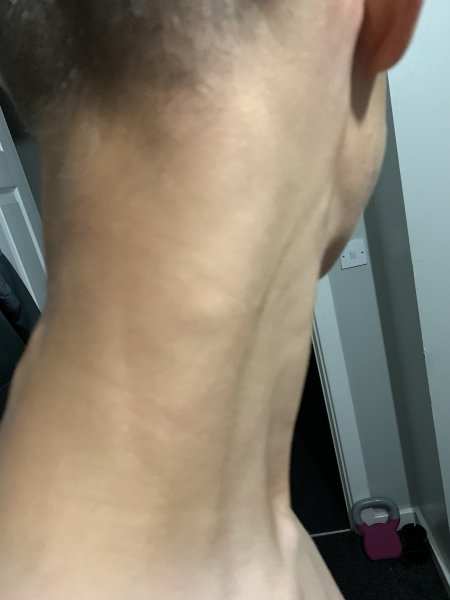 Teenager with ongoing back pain 