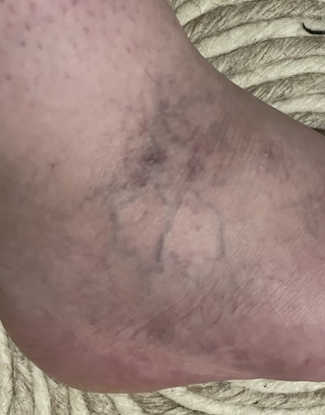 Fractured foot, getting much worse, severe pain and swelling 6 weeks on. Can’t walk.