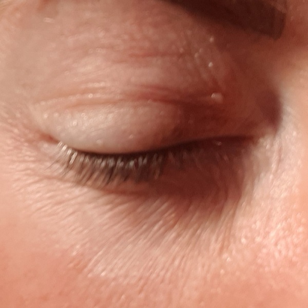 Sensitive eyes following retinol 